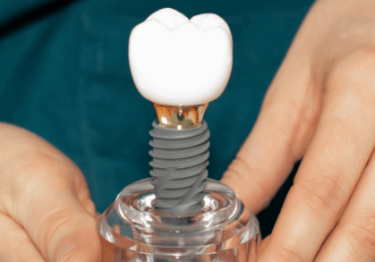 Dental Implant Hygiene