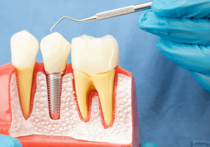 Dentures Vs Implants