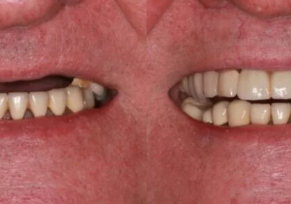 Dental Implant Bridge