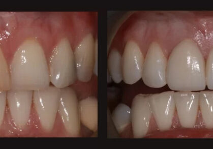 Whitening and Veneers