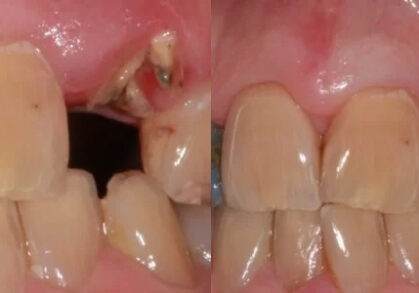 Dental Implant
