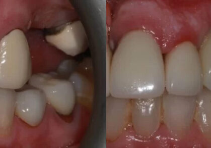 Dental Implant Bridge