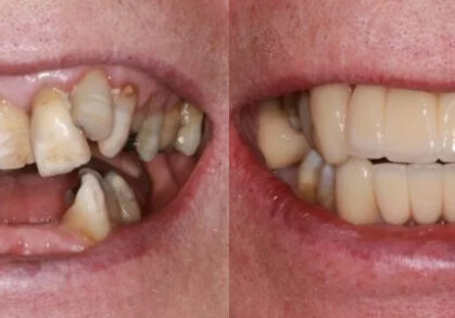 Dental Implant Bridges and Veneers