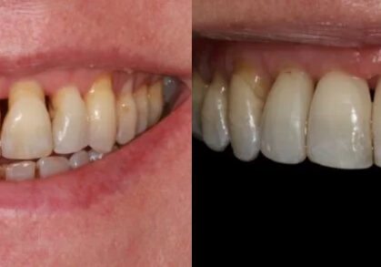 Dental Tissue Graft, Composite Bonding & Teeth Whitening