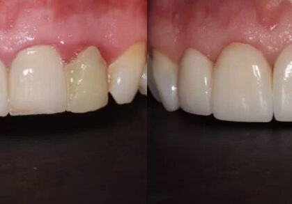 Dental Implant & Crowns