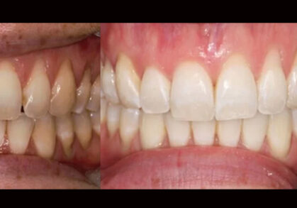 Invisalign® and Whitening