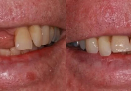 Dental Implant