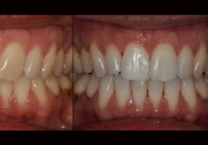 Invisalign® & Whitening