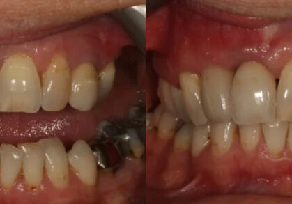 Dental Implant
