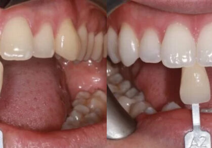 Teeth Whitening