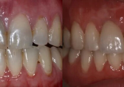 Dental Implant, Gum Grafting, Teeth Whitening and Composite Bonding