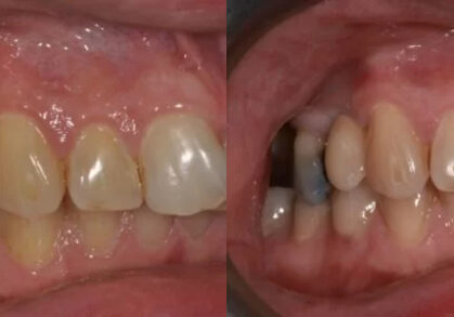 Dental Implant