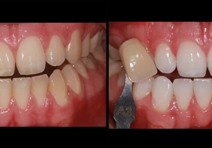 Teeth Whitening
