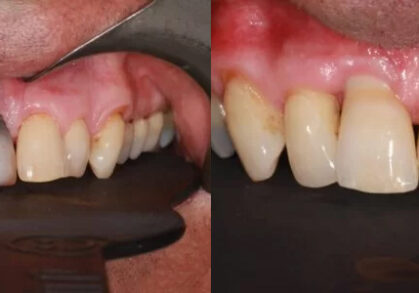 Dental Implant