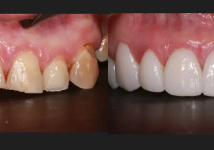 Dental Implant Bridges & Crowns