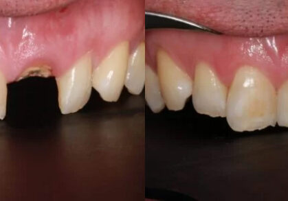 Dental Implant