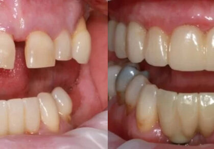 Dental Implant Bridge