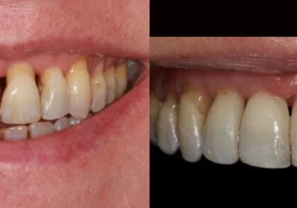 Dental Tissue Graft, Composite Bonding & Teeth Whitening