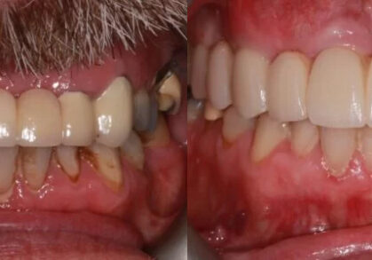 Dental Implant Bridge