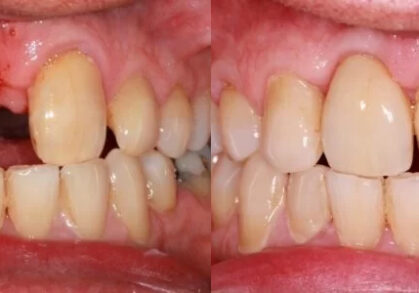 Dental Implant