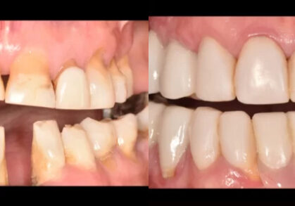 Composite Bonding, Dental Crowns & Denture