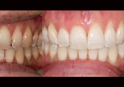 Invisalign® and Whitening