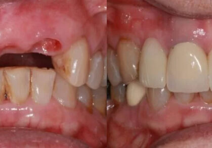 Dental Implant & Bridge