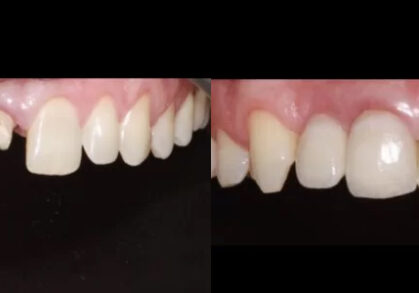 Dental Implants, Porcelain Crown & Teeth Whitening