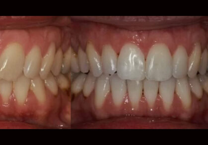 Invisalign® & Whitening