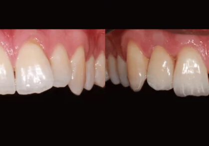 Soft Tissue Grafting & Dental Implants