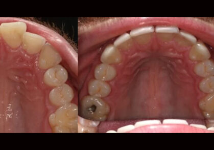 Invisalign®, Whitening & Composite Bonding