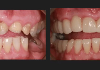 Dental Implant Bridges & Crowns