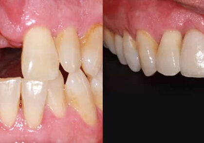 Bone Grafting, Soft Tissue Grafting, Implant & Crown