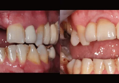 Implant Bridge & Crowns