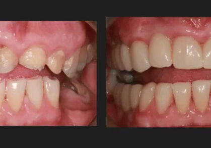 Dental Implant Bridges & Crowns