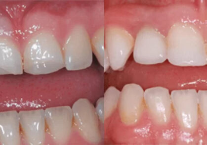 Bone Grafting, Teeth Whitening, Cosmetic Composites & Dental Implants