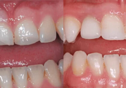 Bone Grafting, Teeth Whitening, Cosmetic Composites & Dental Implants