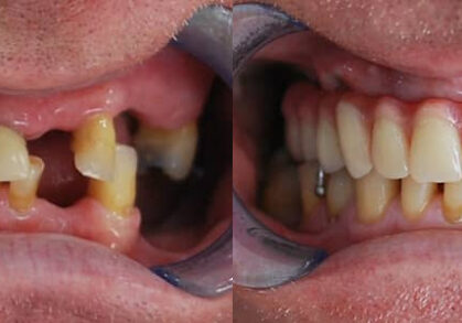 Same Day Teeth & Cosmetic Dentures