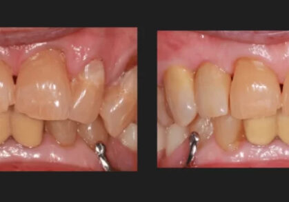 Dental Implant Bridge