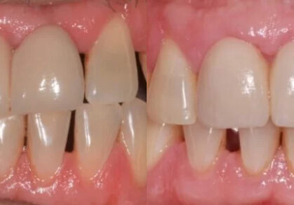 Dental Bridge & Gum Grafting