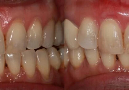 Gum Recession Surgery