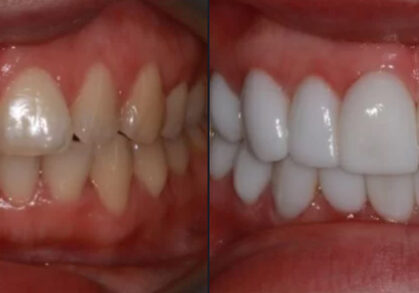 Veneers