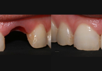 Dental Implant