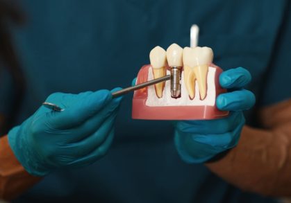 The Dental Implant Procedure Explained Step by Step
