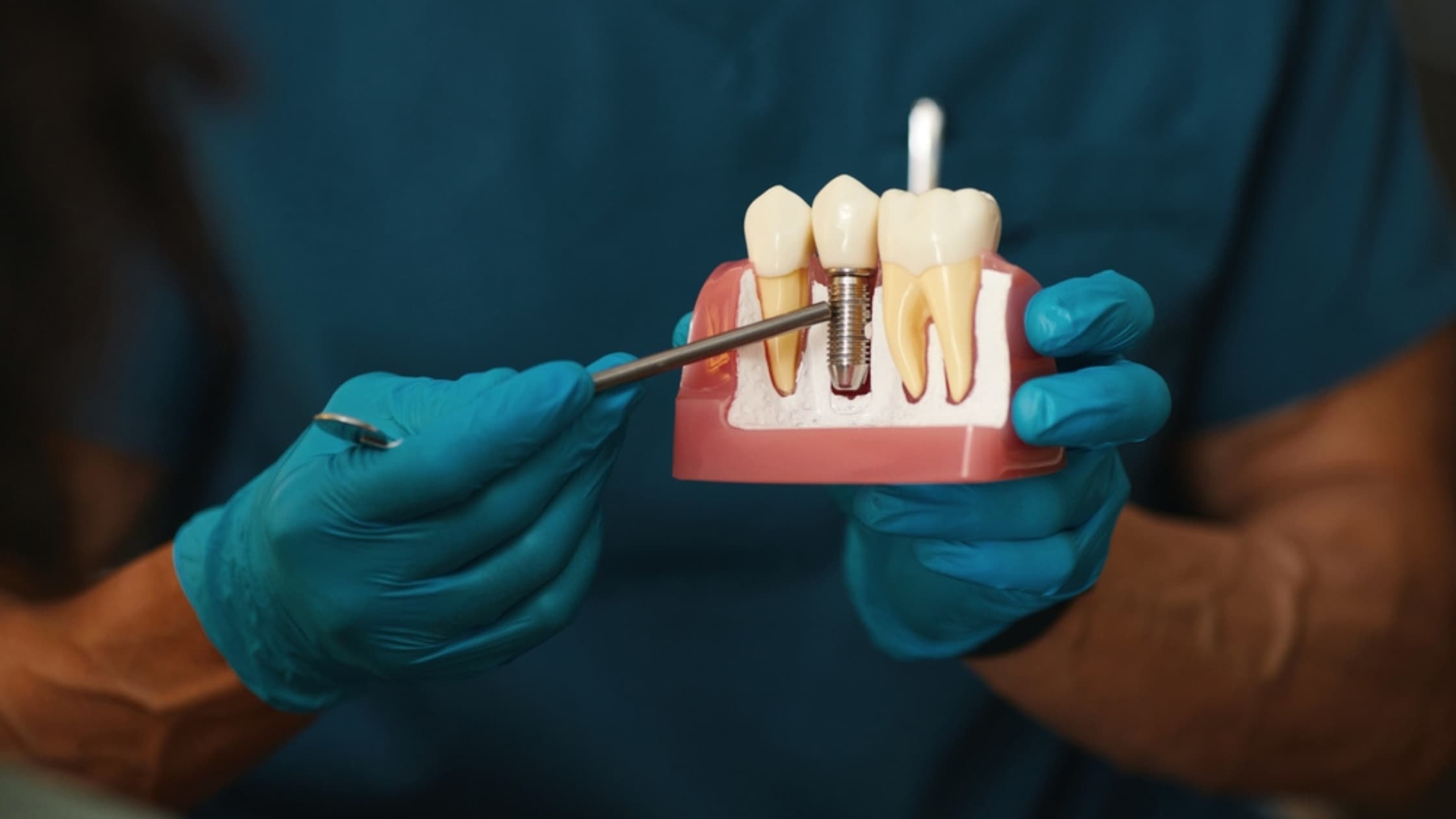 The Dental Implant