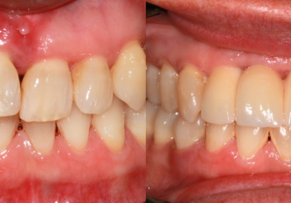 Dental Implants